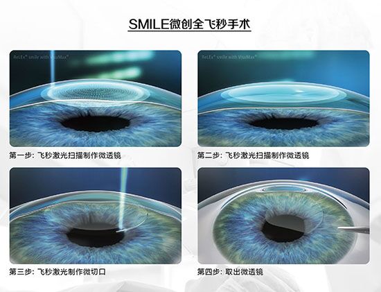 蔡司全飛秒、蔡司半飛秒近視手術與宇航飛秒的區別